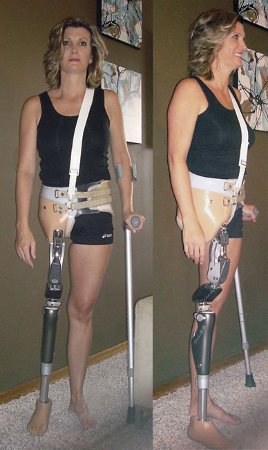 Image of patient who has undergone hemipelvectomy and hip disarticulation wearing custom-fitted prosthesis